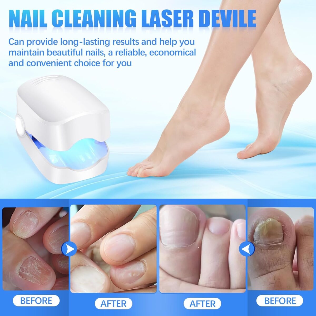 Rechargeable Nail Fungus Laser â€“ Anti-Fungal Device for Toenails, Hands & Feet (Home Use) - Image 5